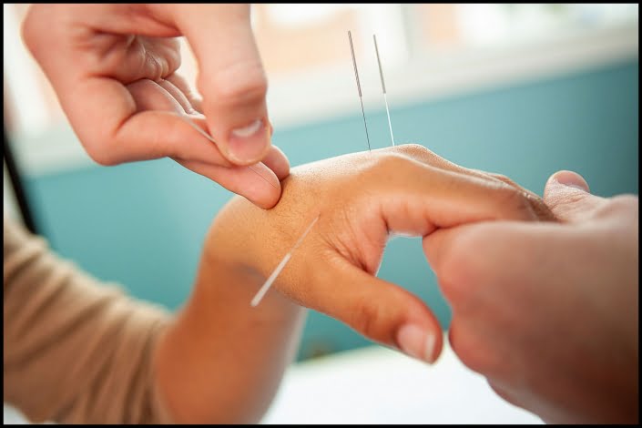MIchael LoBiondo Photography - Acupuncturist putting needles into patients hand