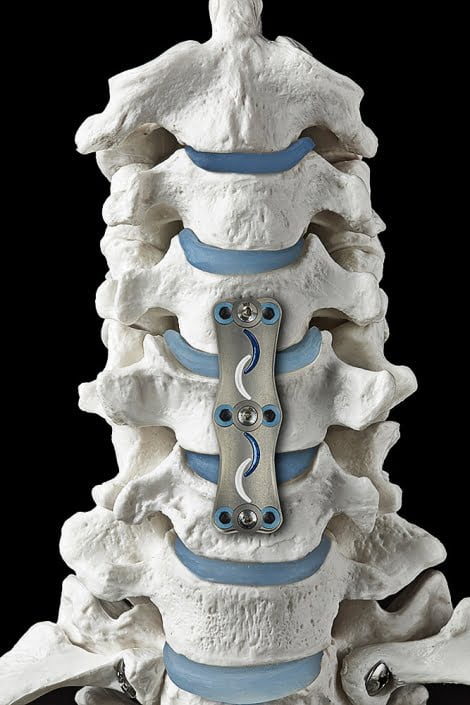 Michael LoBiondo Photography - Metal spine device displayed over spine